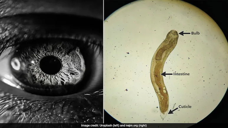 Verme no olho deixa homem indiano com visão turva nos USA