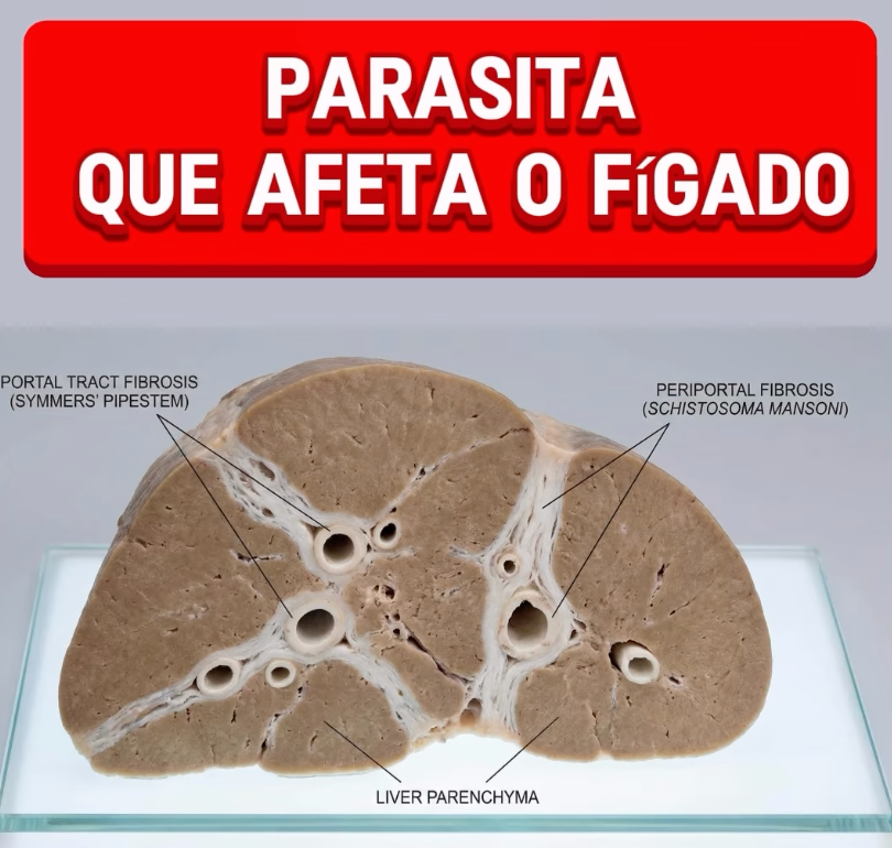 Parasitas no fígado causados pelo Schistosoma mansoni afetando as veias hepáticas